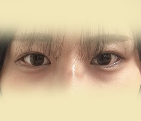 매몰+뒤트임+밑트임 후기!!!