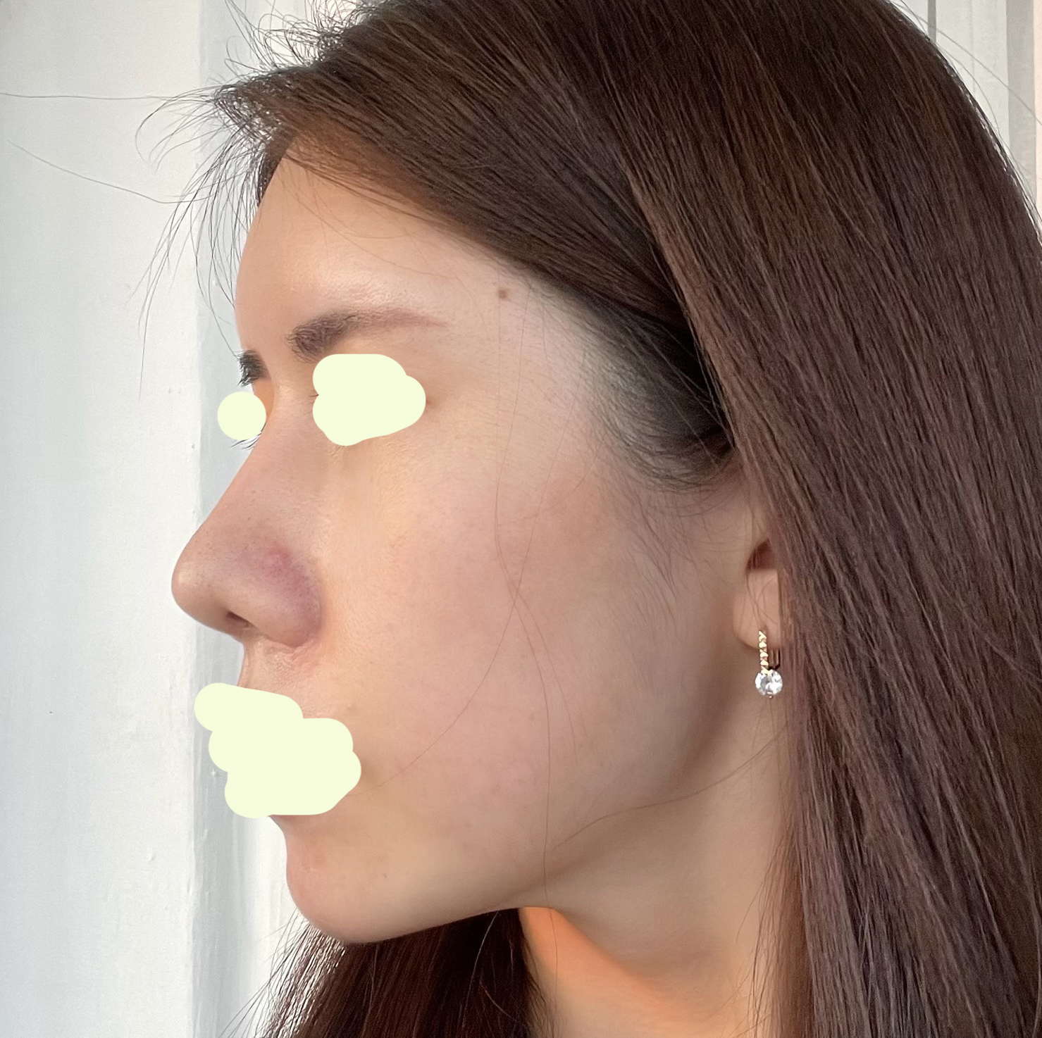 코+눈밑지방재배치+지방이식 후기-8개월차