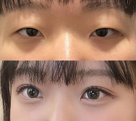 눈매교정 잘된거같죠??ㅎㅎ