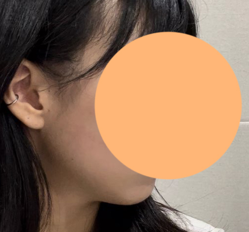 얼지흡후기! 붓기많이 빠지고 만족만족