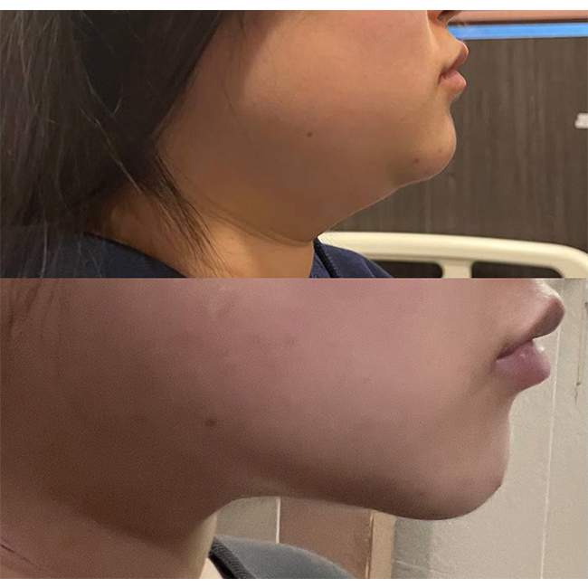 수술전후측면.jpg