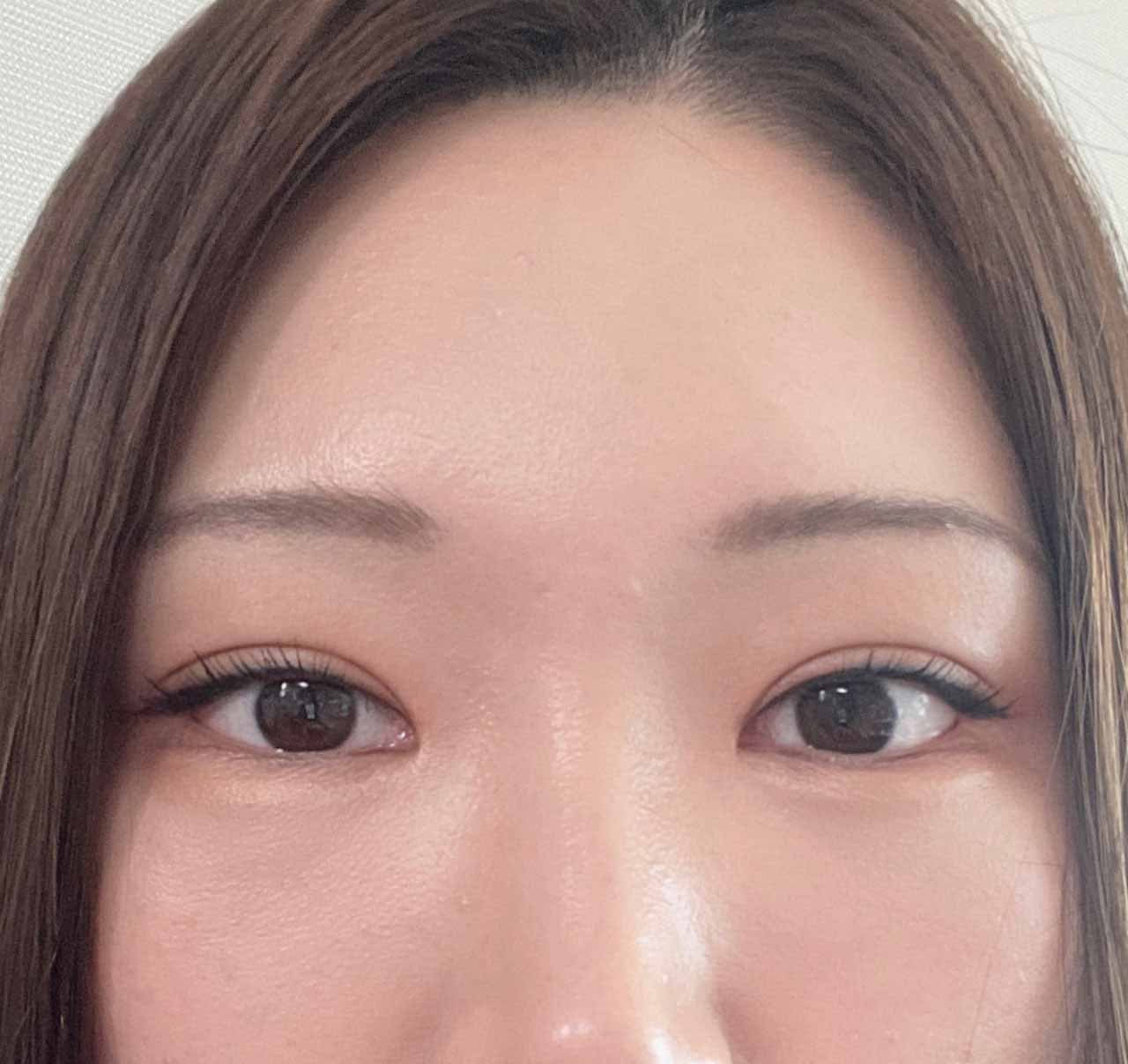 쌍꺼풀 라인 비대칭 완벽 해결^^