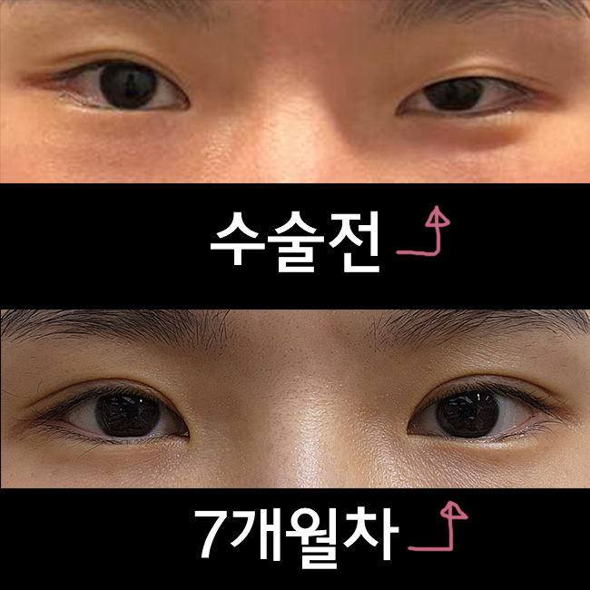 친구소개로 바이브에서 눈재수술한지 7개월차!