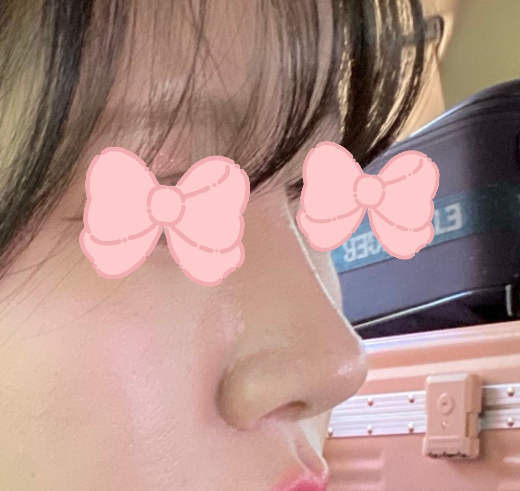 첫코, 눈재수술 유영문원장님께 받았습니다!