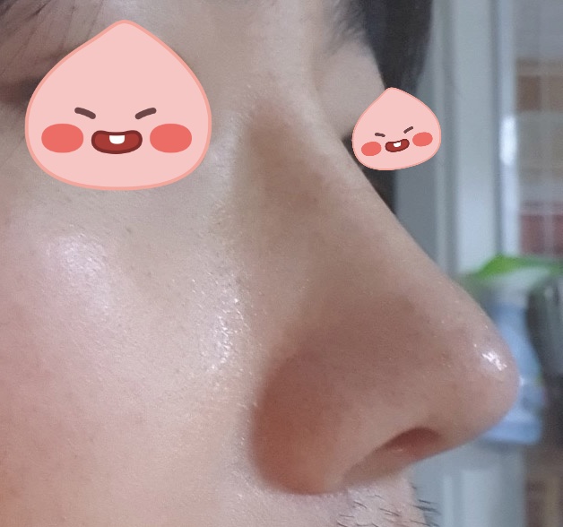 코재수술 만족후기씁니다~