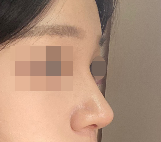 눈, 코성형알아보시면 바이브 적극추천왕추천!!