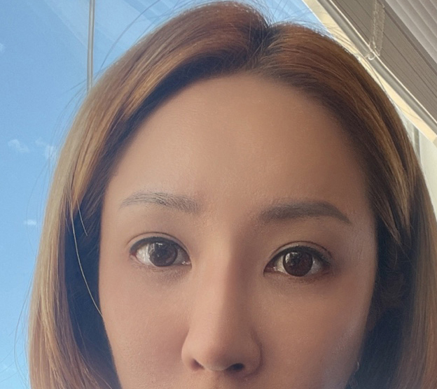 눈, 코, 이마거상, 실리프팅 3개월차!!