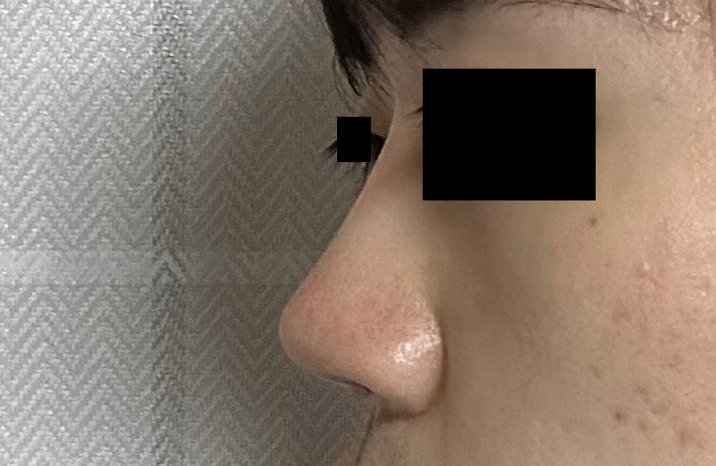 남자코수술 고민중이라면 바이브추천!