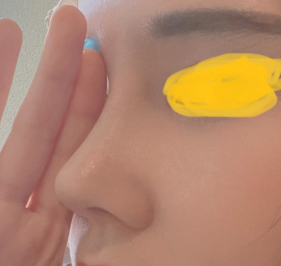 코재수술 복코도 개선되고 베리굳!