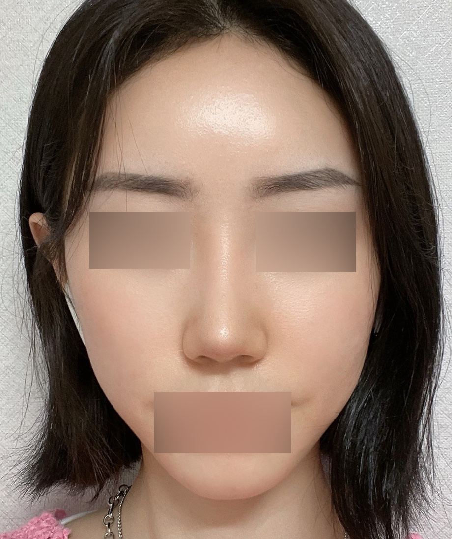 코성형+풀페이스지방이식 6개월 후기입니당