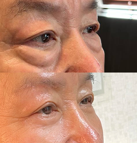 아버지 눈썹하거상, 하안검 후기입니다^^