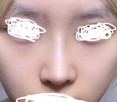 낮고 동글동글했던 코, 성형한 후기!!