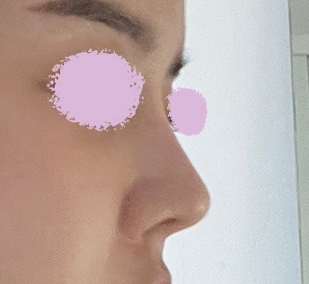 코재수술 6개월지나고 후기작성합니당