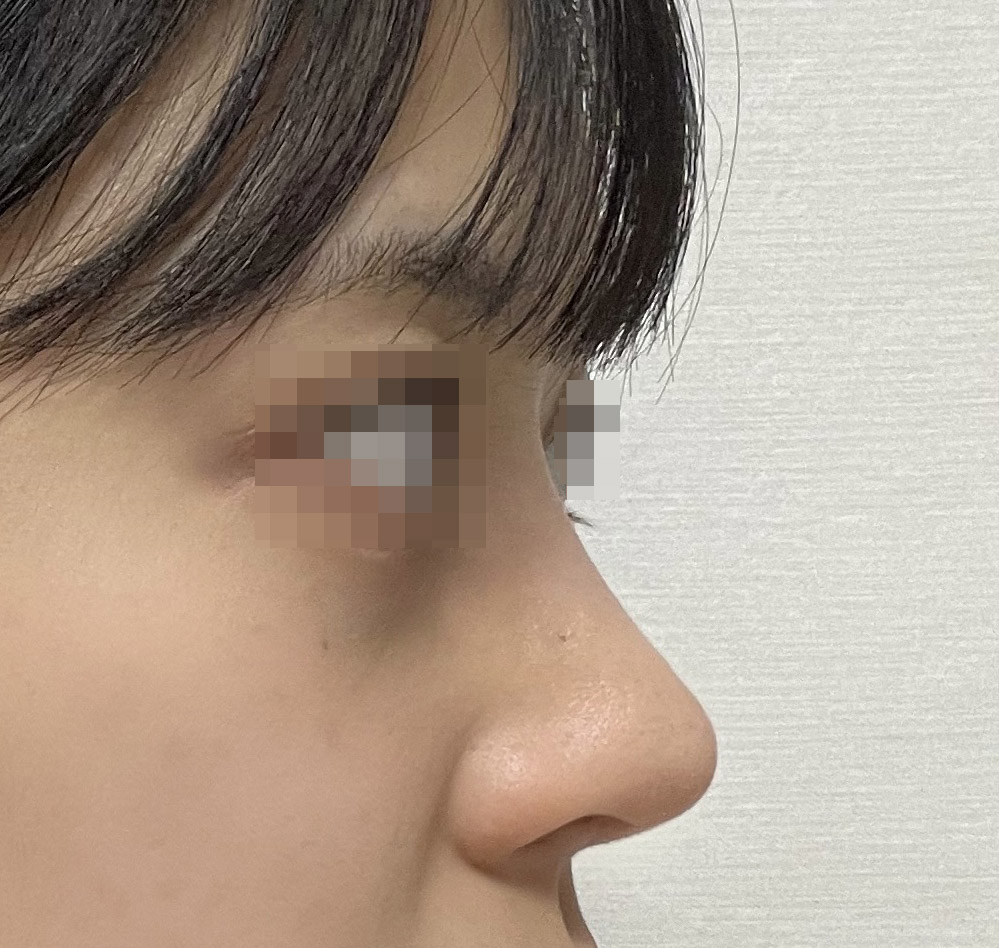 부산에서 와서 수술받은 보람이 있어요ㅎㅎ