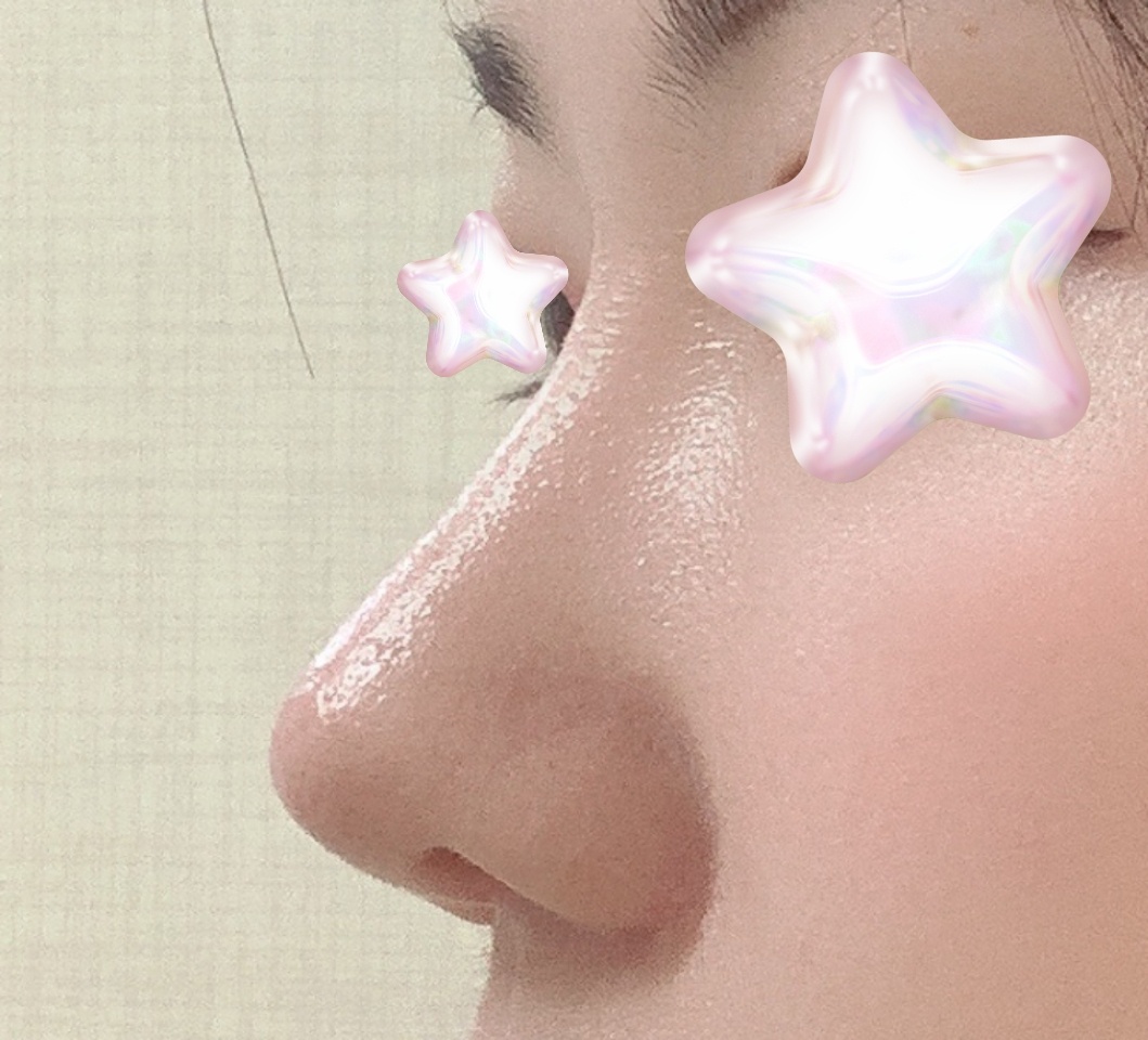 복코성형 6개월차입니다:) 바이브추천!