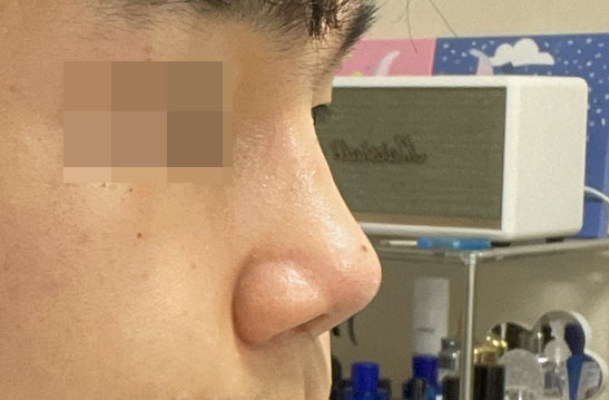 남자코성형 정말 잘됐습니다!!