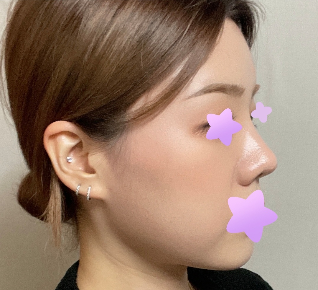 유영문원장님께 수술받은지 어느덧 4개월됐습니다!