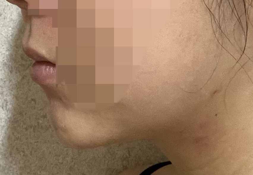 얼굴지흡=유영문원장님 추천 ㅋㅋ