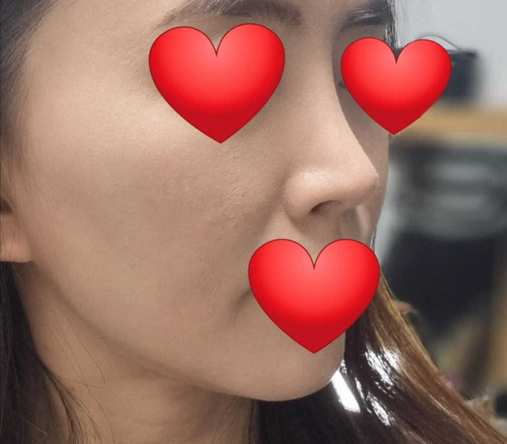 코재수술 맛집!!굿굿