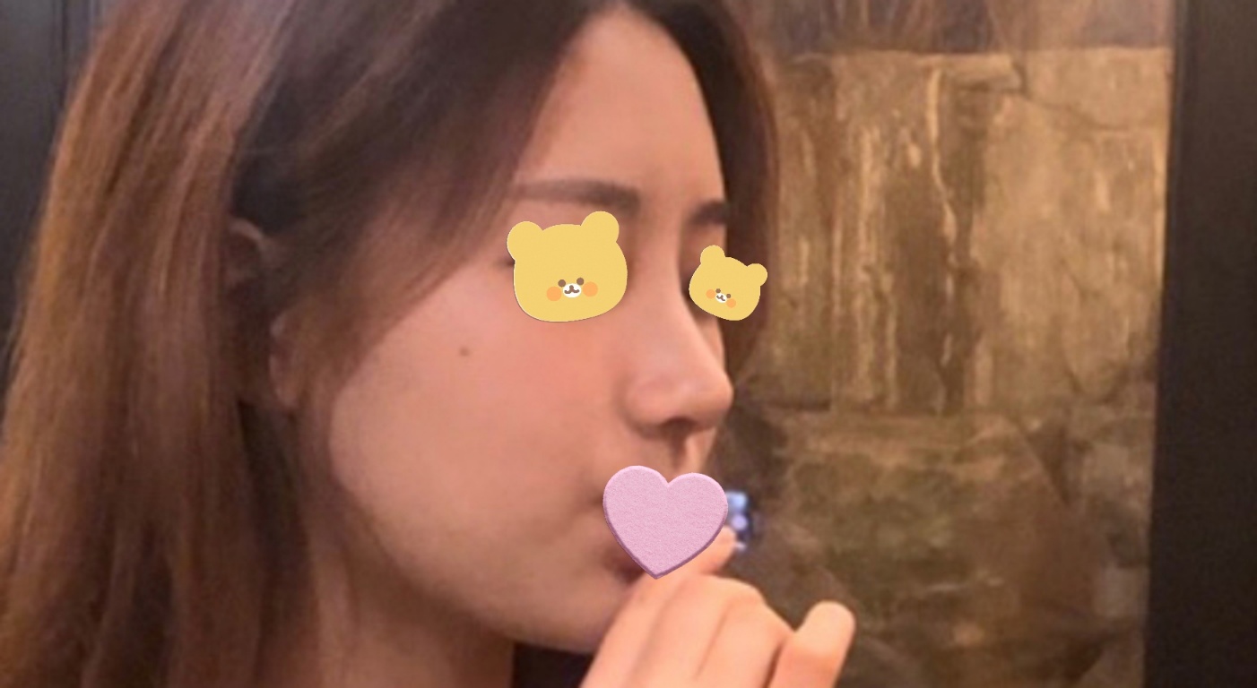 무보형물코성형 후기임당