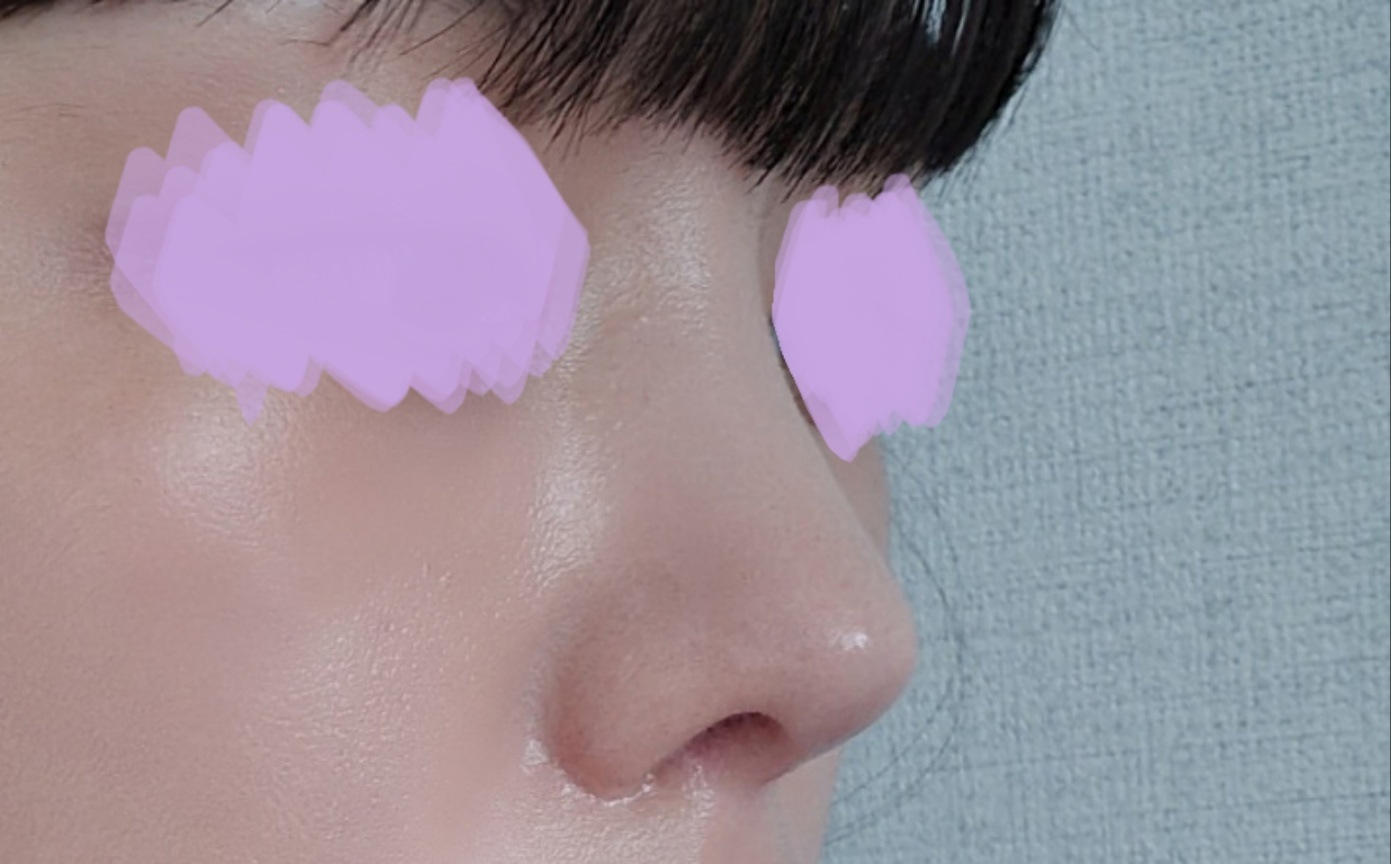 무보형물 코재수술만족만족 굿