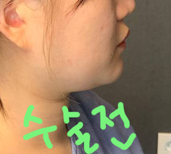 수술전_1_.jpg