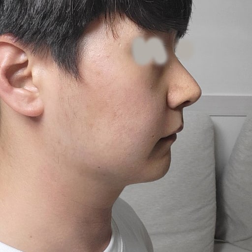 무보형물 코 수술했습니다