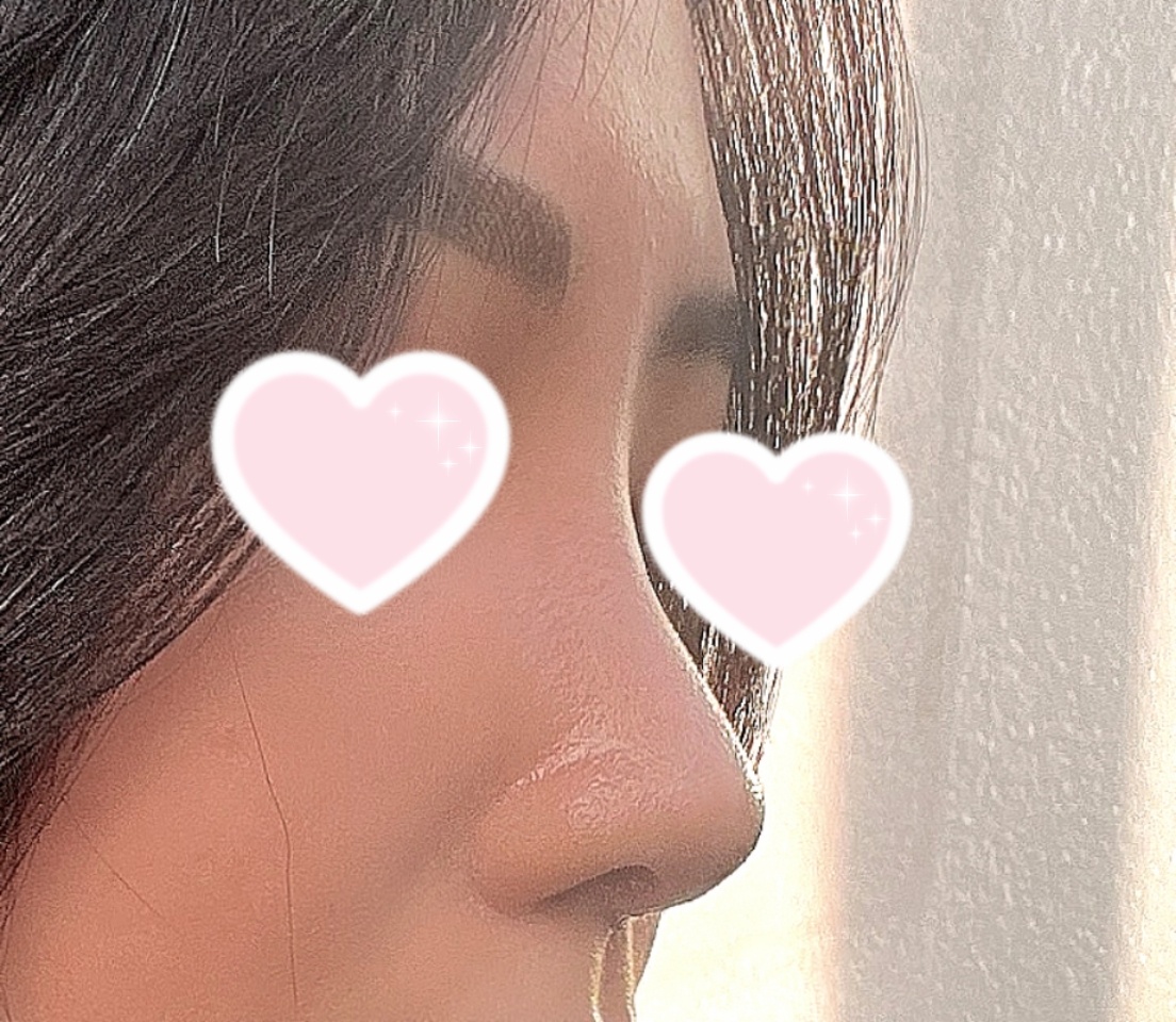 낮은코,짧은코성형 잘됐죠??