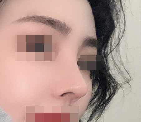 바이브 코성형맛집이라고 할만해요!