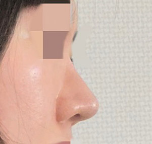 무보형물코수술+얼굴지방흡입 5개월차:)