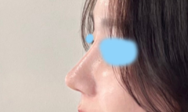 코수술한지 2개월 지나고 후기씁니다!