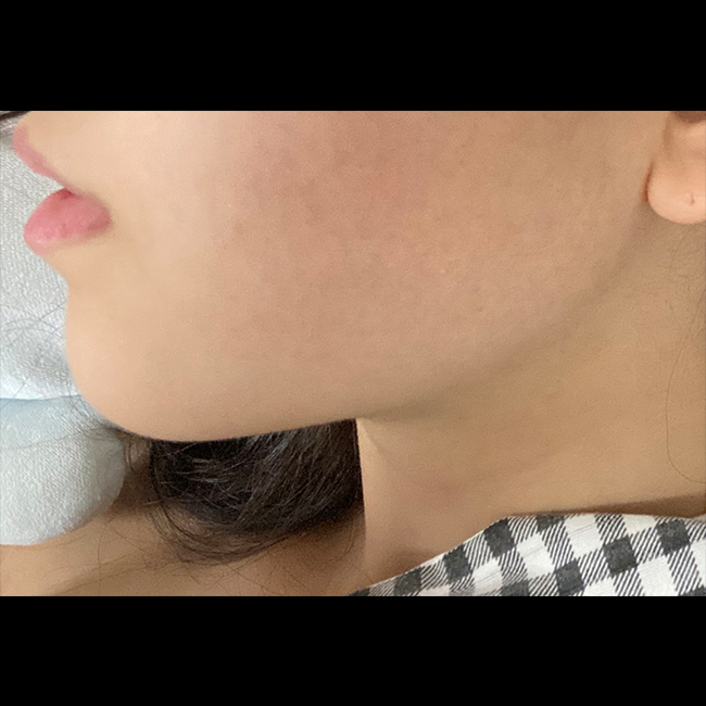 이제 턱살때매 스트레스 받을 일 없어유 ㅎㅎ