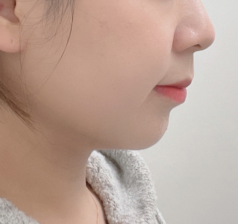 얼지흡으로 투턱살 완죤 꼼꼼하게 빼주심!