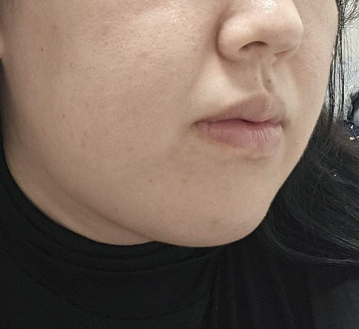 얼지흡하고나니 투턱 사라져써요~~~