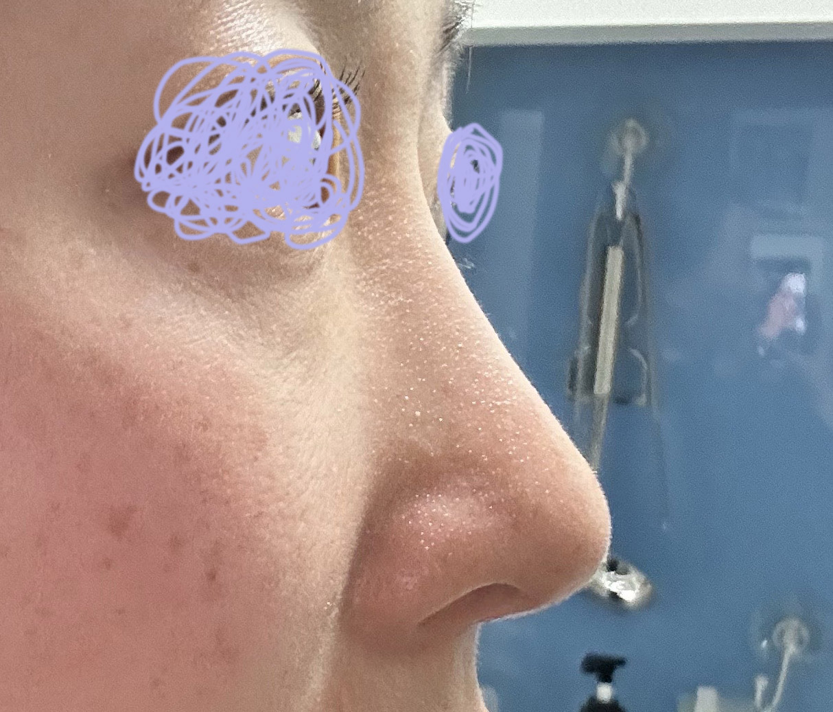 코 자연스럽고 예쁘게 잘 된거 같아요~!