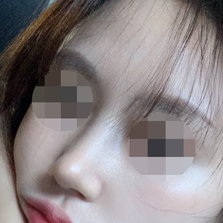 무보형물 3개월차!