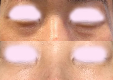 눈밑지방재배치 4개월차 만족후기^^