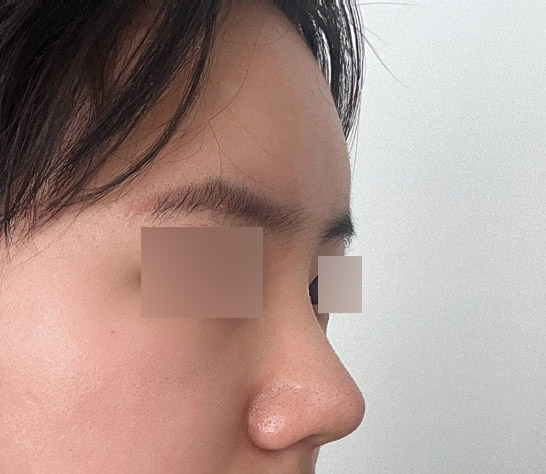 코+지방이식하구 라인 넘 이뻐졌어요 ㅎㅎ