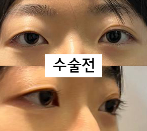 수술전_1_1.jpg
