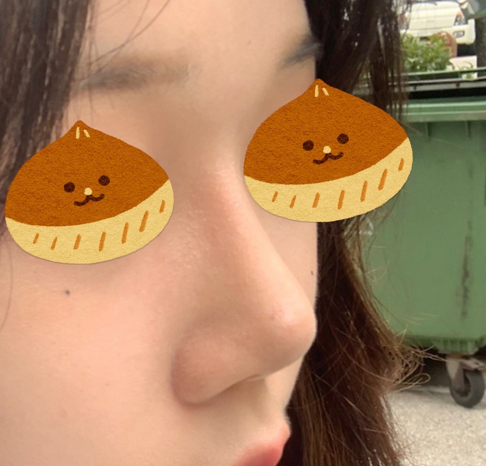 코수술 잘됐다고 주변에서 그러네요ㅎㅎ