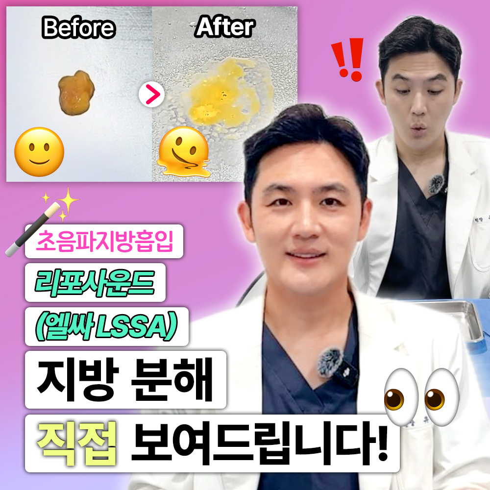 초음파지방흡입 | 리포사운드(엘싸 LSSA) | 지방 분해 과정