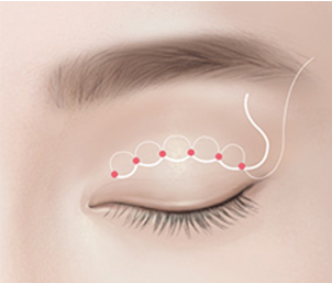 비절개 눈매교정 Step 03