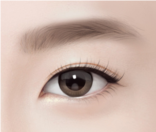 비절개 눈매교정 Step 04