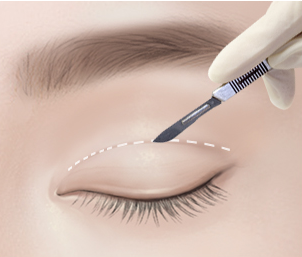 절개 눈매교정 Step 02