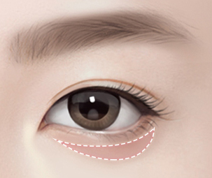 하안검성형술 Step 01