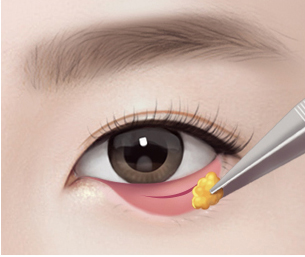 눈밑지방재배치 Step 02