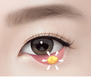 눈밑지방재배치 Step 03