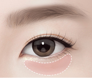 눈밑지방이식 Step 01