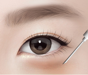 눈밑지방이식 Step 03