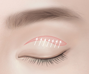 상안검성형술 Step 03